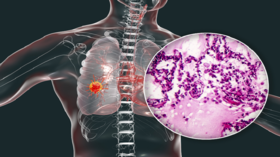 Cancer progression with “available drugs” targeting 80% of lung tumors following “unique” discovery!