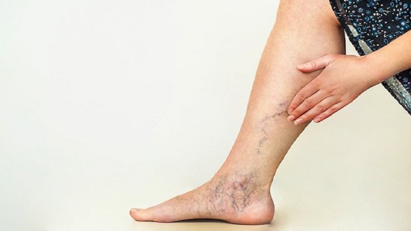 Keep this up .. 7 exercises to get rid of varicose veins in a good way